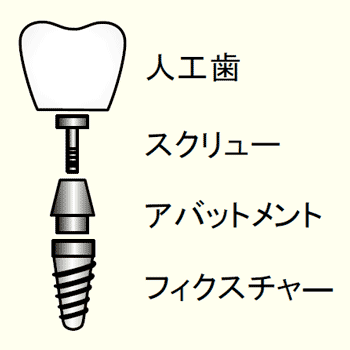 歯科用インプラント