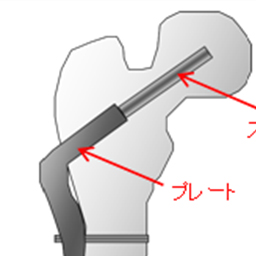 大腿骨骨折用インプラントの応力解析、疲労解析