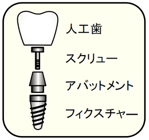 歯科用インプラント承