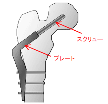 大腿骨頸部骨折治療用インプラントの概要