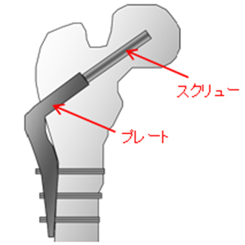 大腿骨骨折用インプラントの応力解析、疲労解析