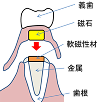義歯用磁性アタッチメントの磁気特性評価