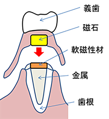 図1 磁性アタッチメント模式図