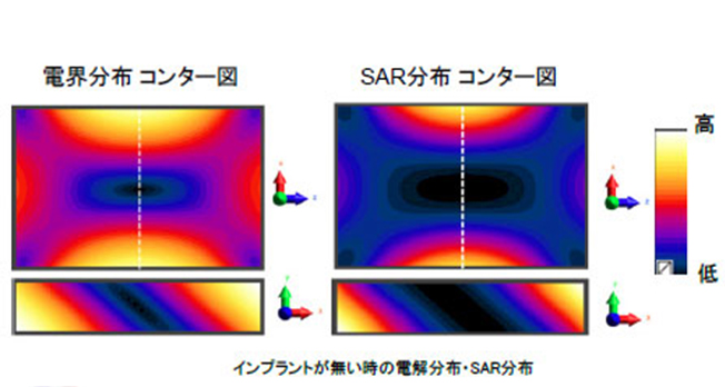 インプラント発熱計算の解析モデル