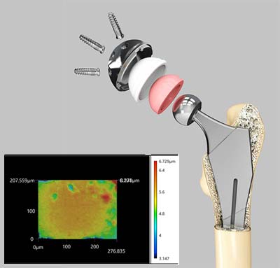 人工股関節の例写真